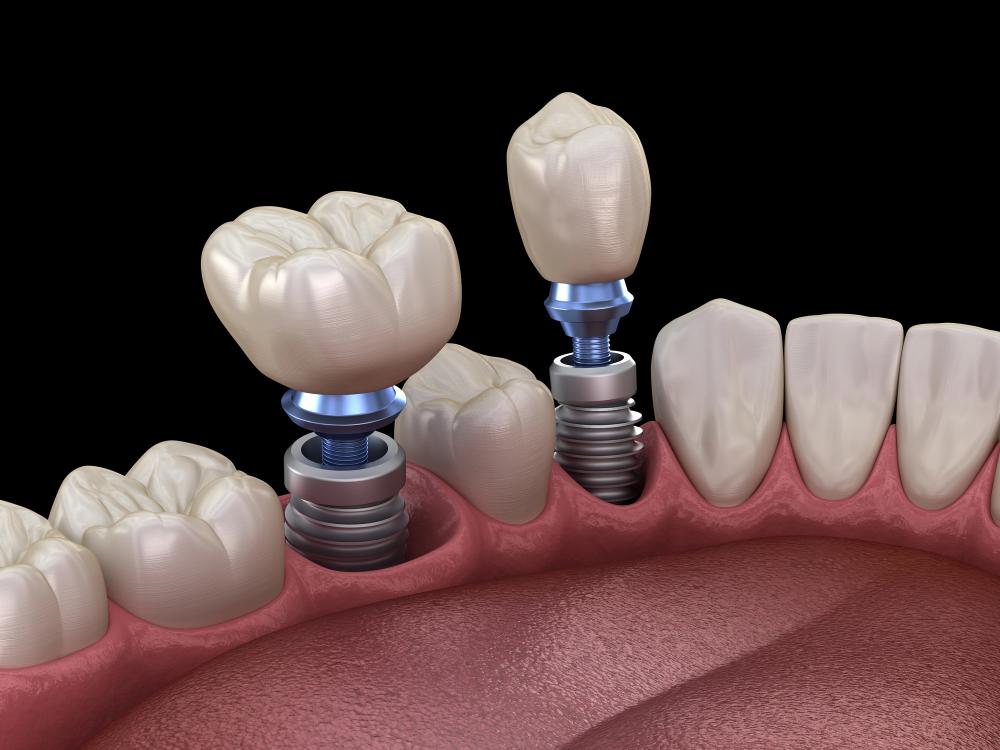 dental implant abutment types