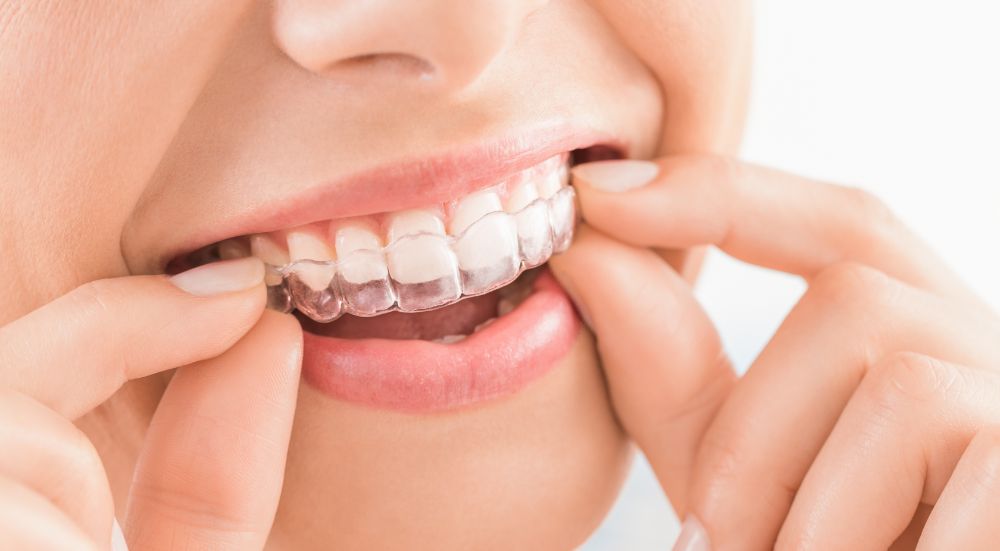 How long does it take to adjust to Invisalign