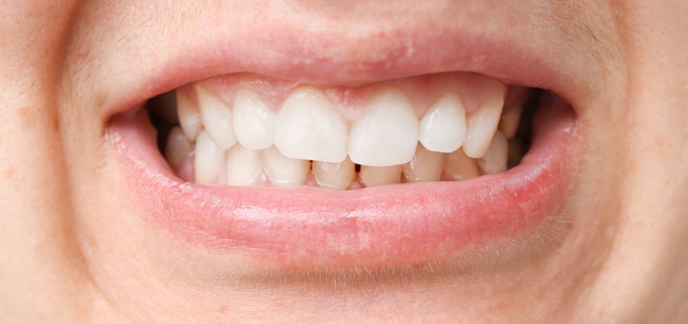 teeth misalignment
