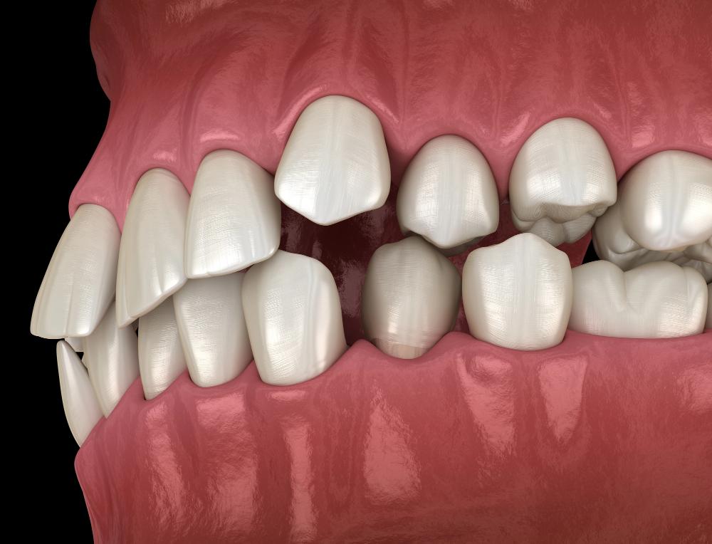 can you get veneers on crooked teeth