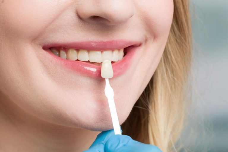 Can You Still Get Veneers if You Have Teeth Grinding Issues?