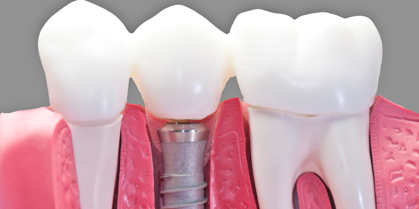 Dental Implants post surgery care