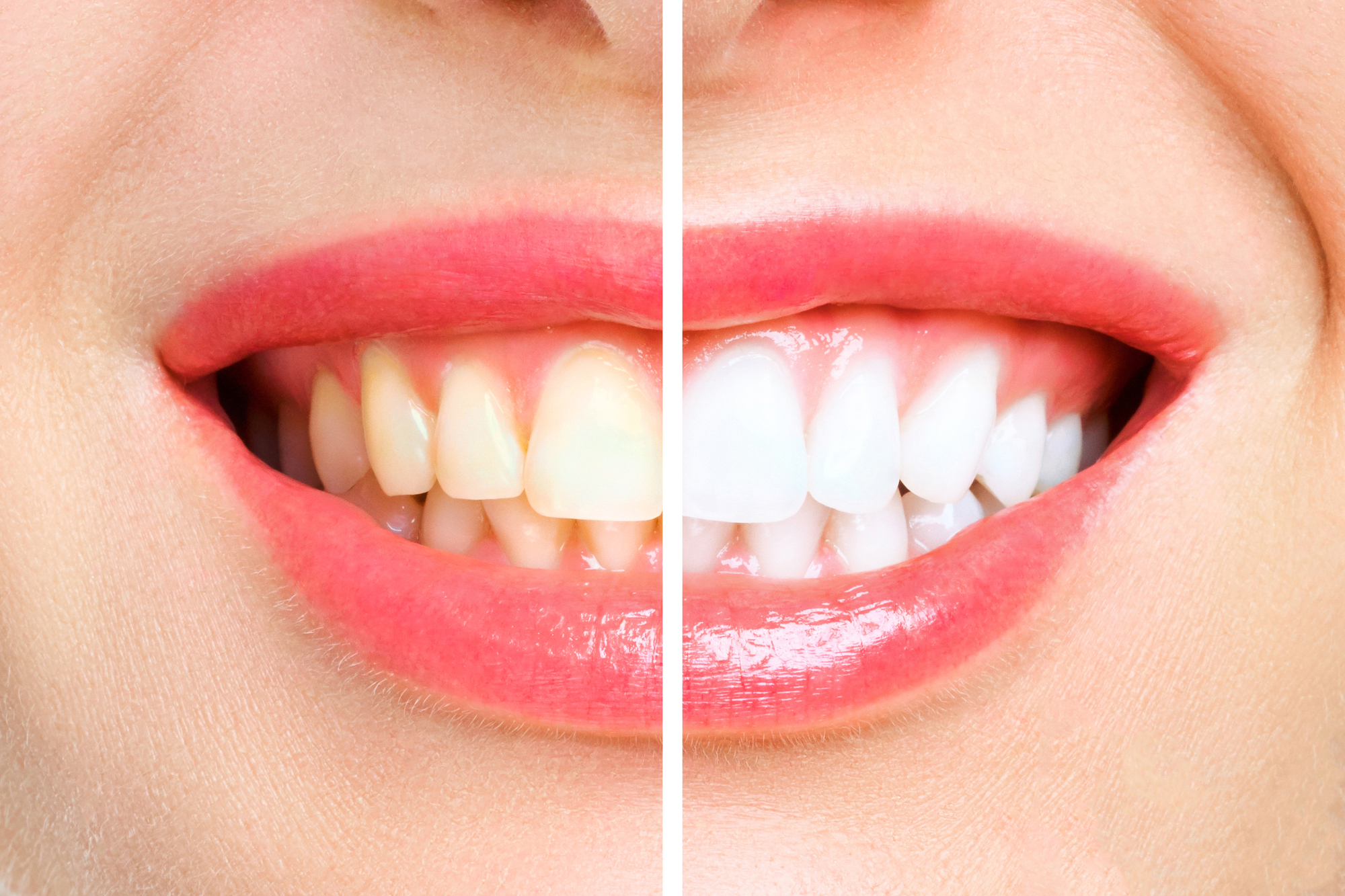 sensitive teeth whitening