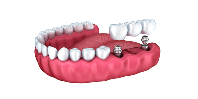 replace dental implants