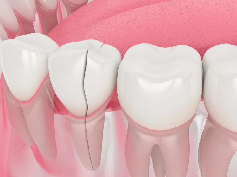 does a cracked tooth need a root canal