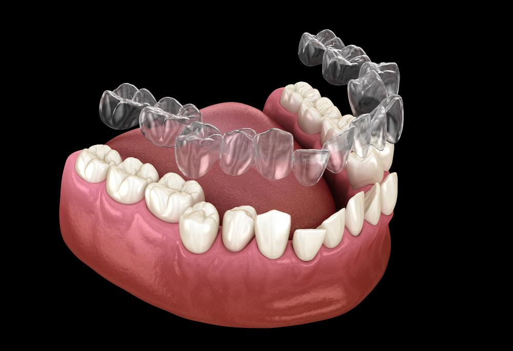 does invisalign cause gum recession