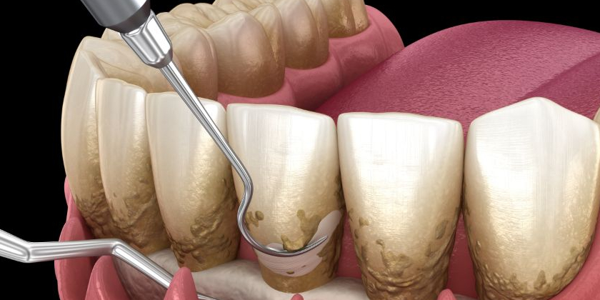Find Out If You Are At Risk Of Contracting Periodontal Disease