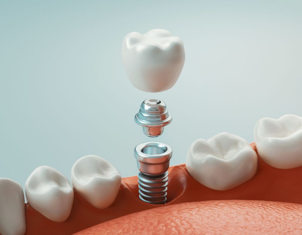 How Long Can Dental Implants Last