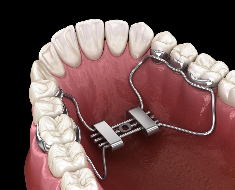 subperiosteal dental implants