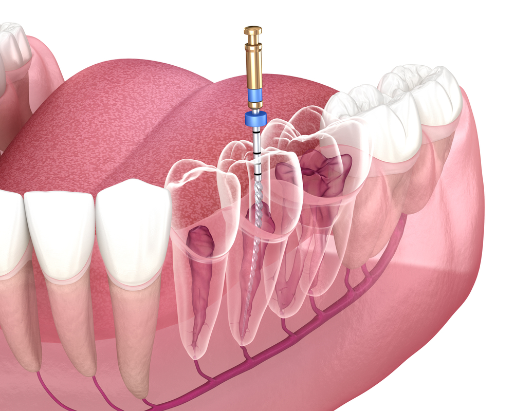 Avoid Root Canal