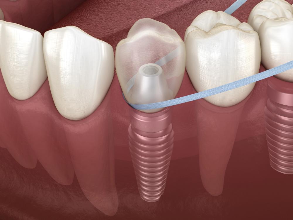 how to floss dental implants