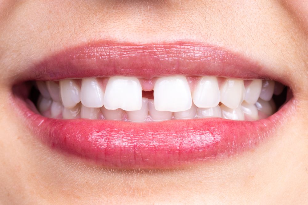 Gaps In Teeth