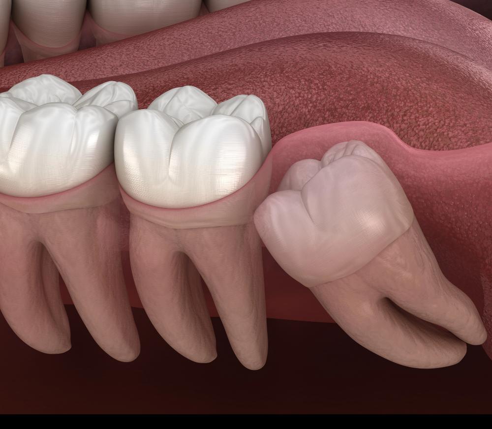 impacted vs. erupted wisdom teeth