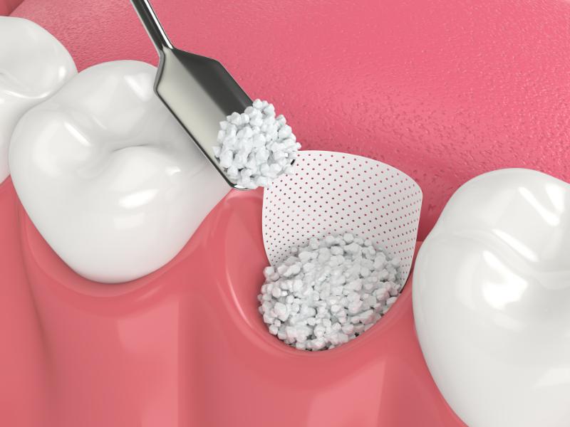 is bone graft necessary after extraction