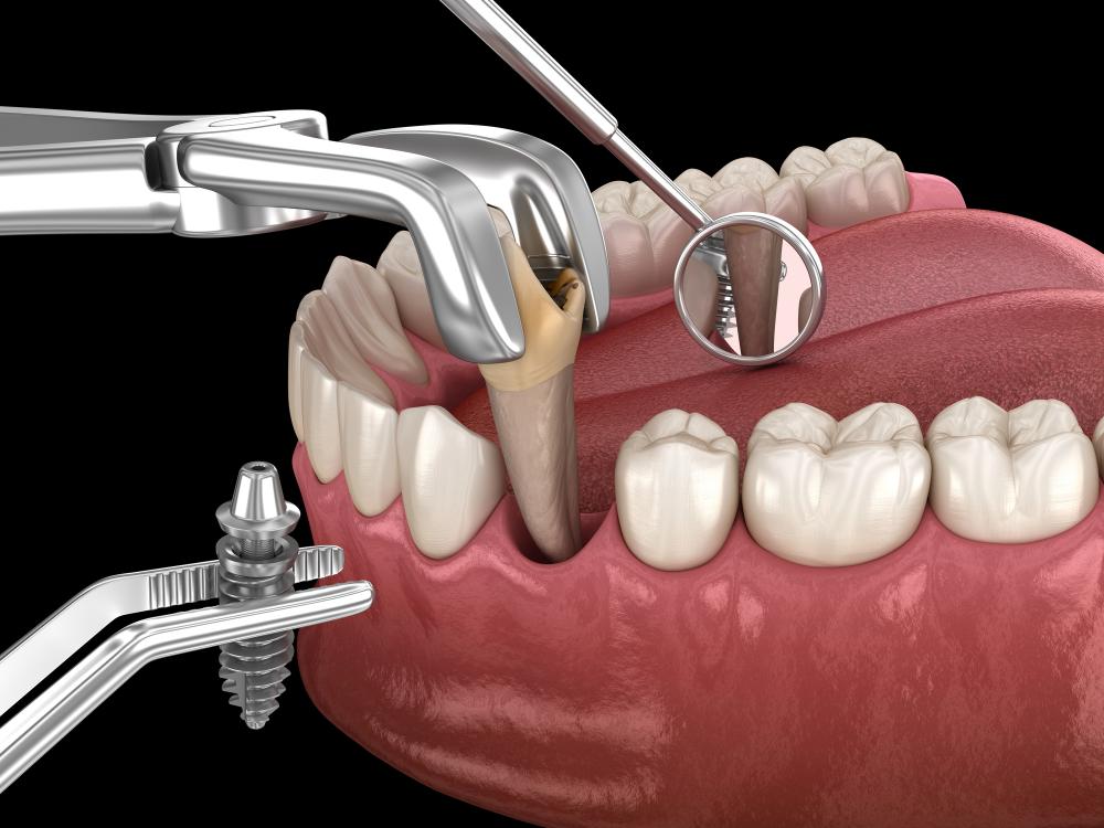 teeth extraction dentist
