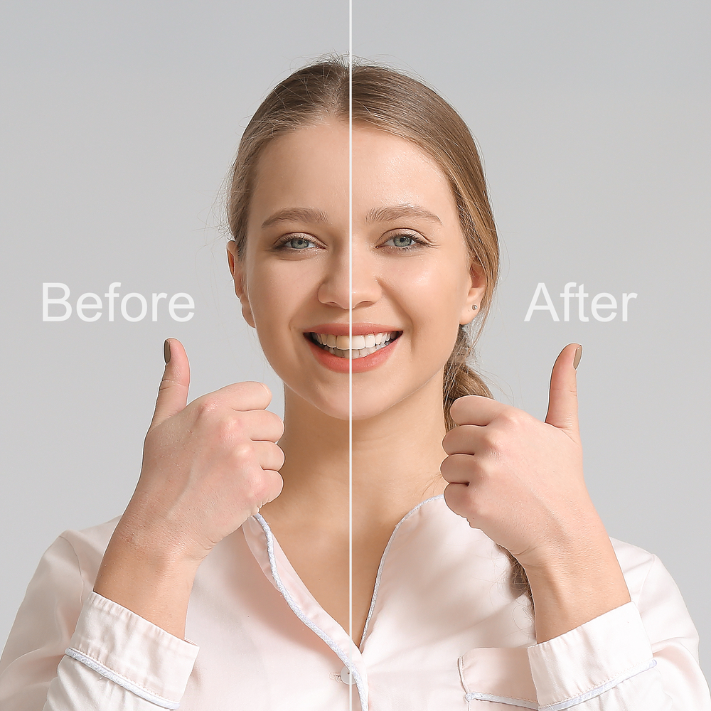 smile makeover process
