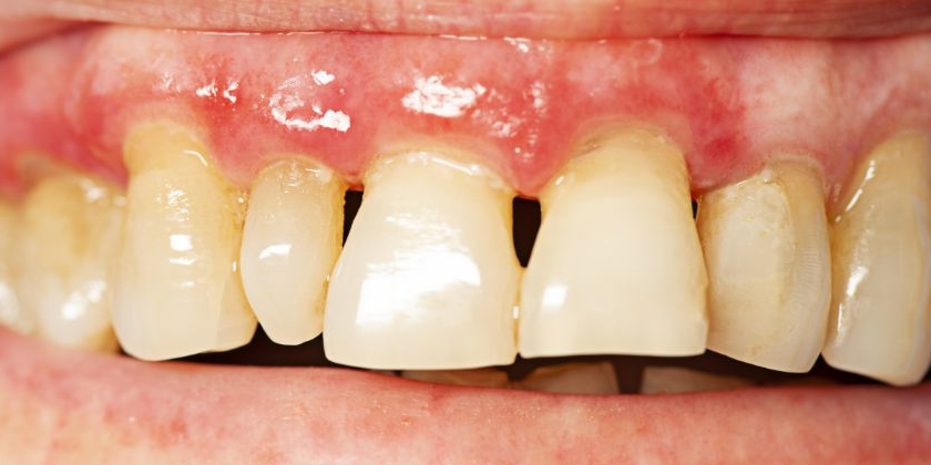 Symptoms Of Periodontal Disease To Look Out For