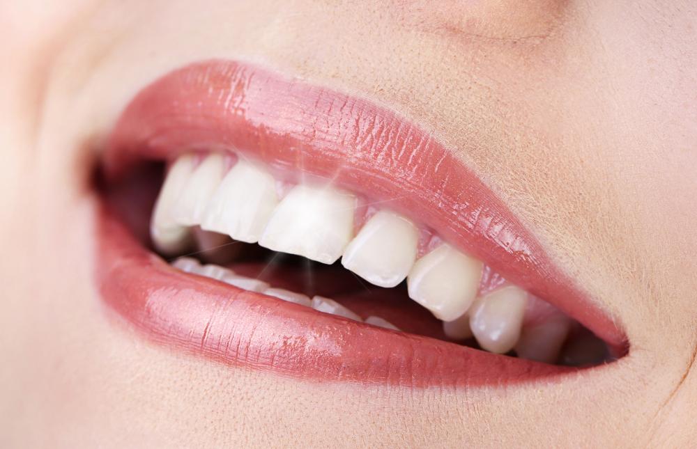 teeth whitening vs teeth bleaching