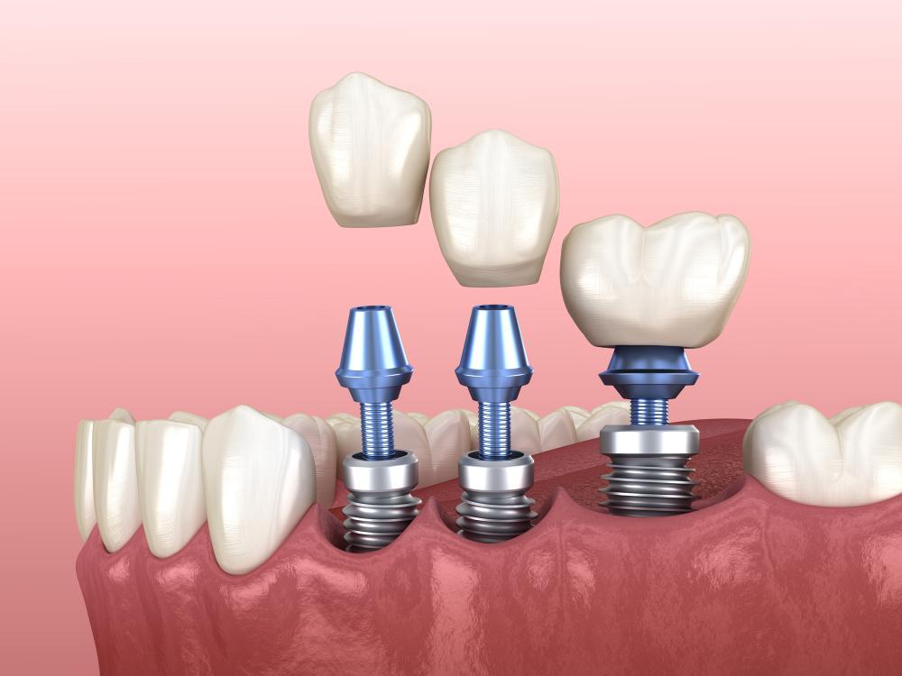 titanium dental implants
