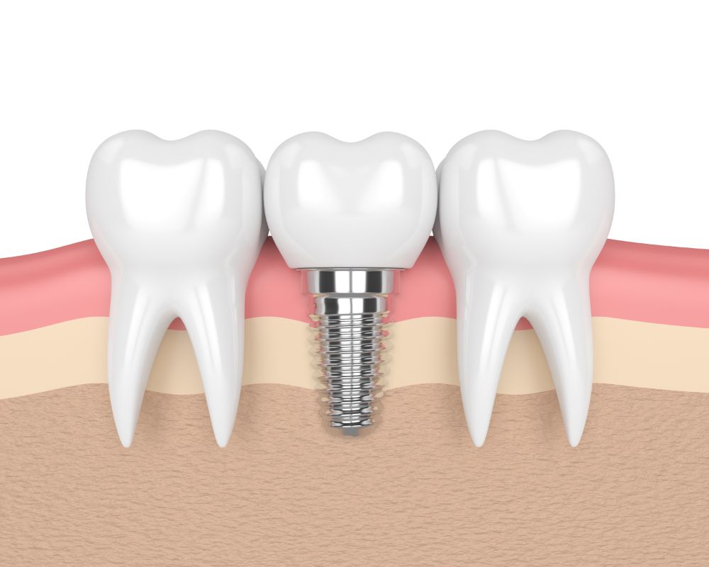 Dental Implant Abutment