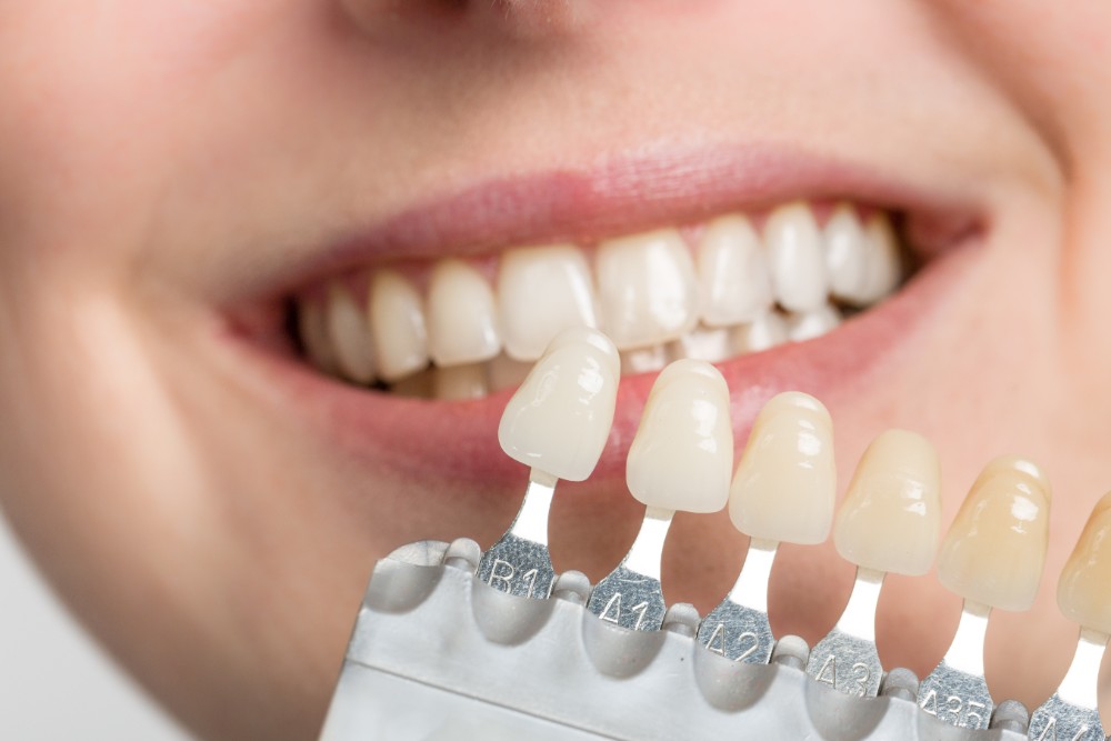 Veneers And Composite Resin Bonding - The Difference