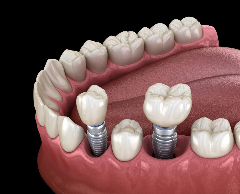 what are dental implants made of