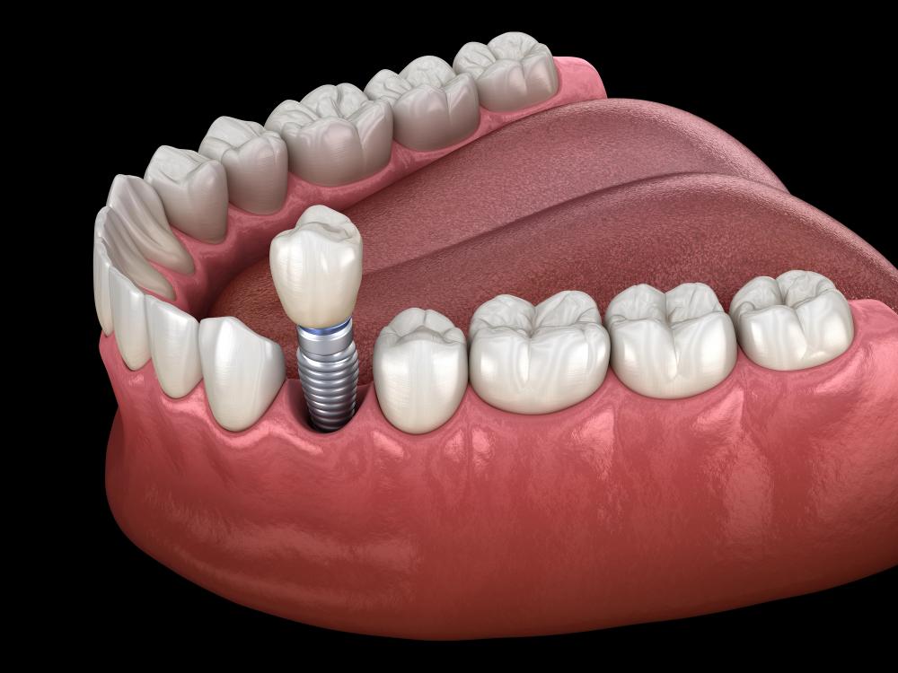 screwless dental implants