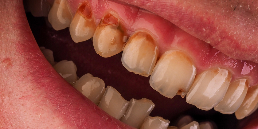 Gum Disease major signs