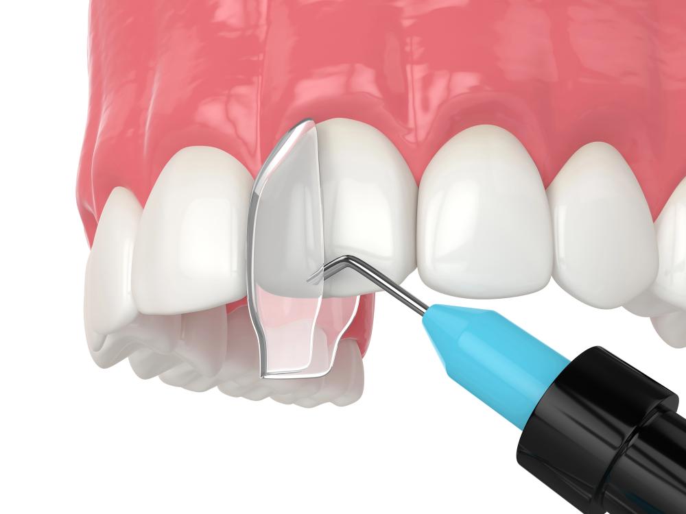 cosmetic dental bonding