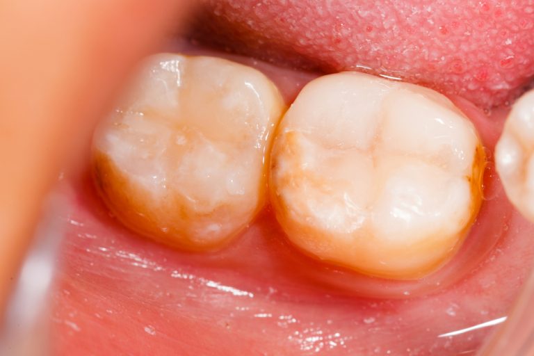 What You Can Do To Prolong The Life Of Your Composite Resin Fillings Dr. Alex Midtown NYC