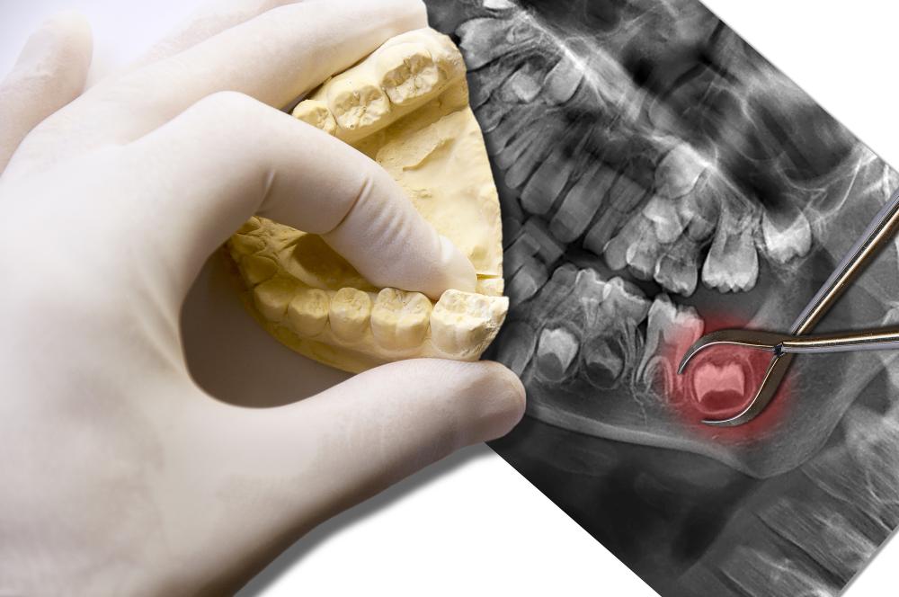 Wisdom Tooth Extraction