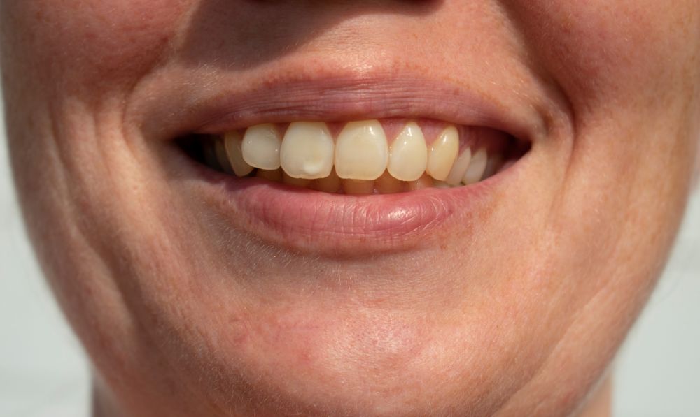 White Spots On Teeth