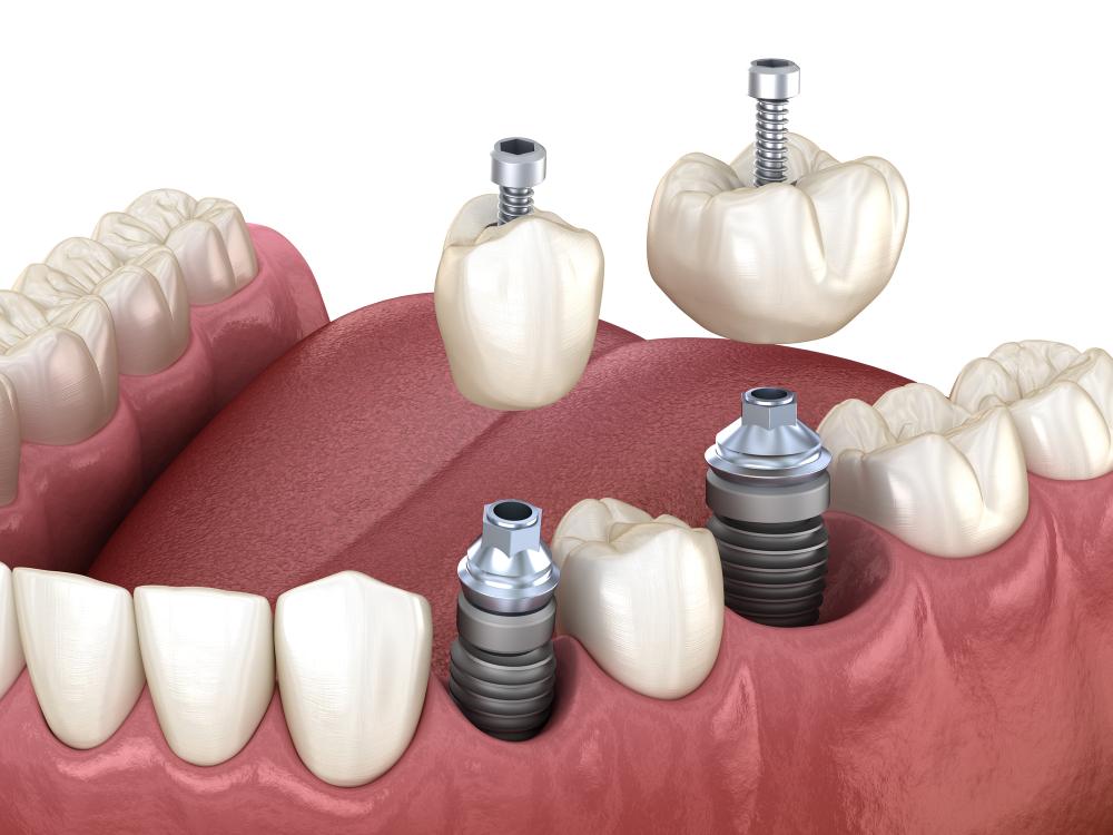 dental implants in NYC