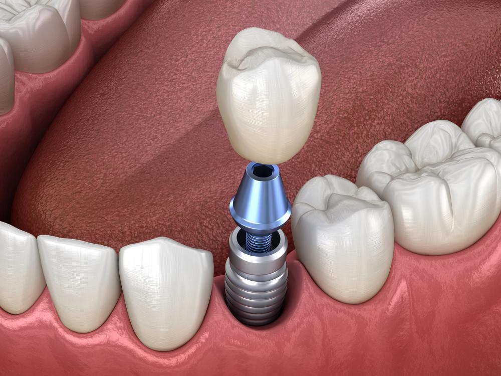 dental implant fell out