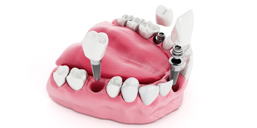 Dental Implants fail