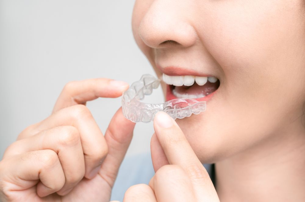 Widen smile with Invisalign