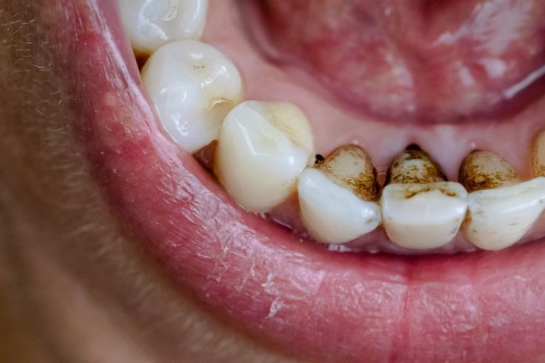 Worried About Coffee Stains On Your Teeth Dr Alex Midtown Nyc