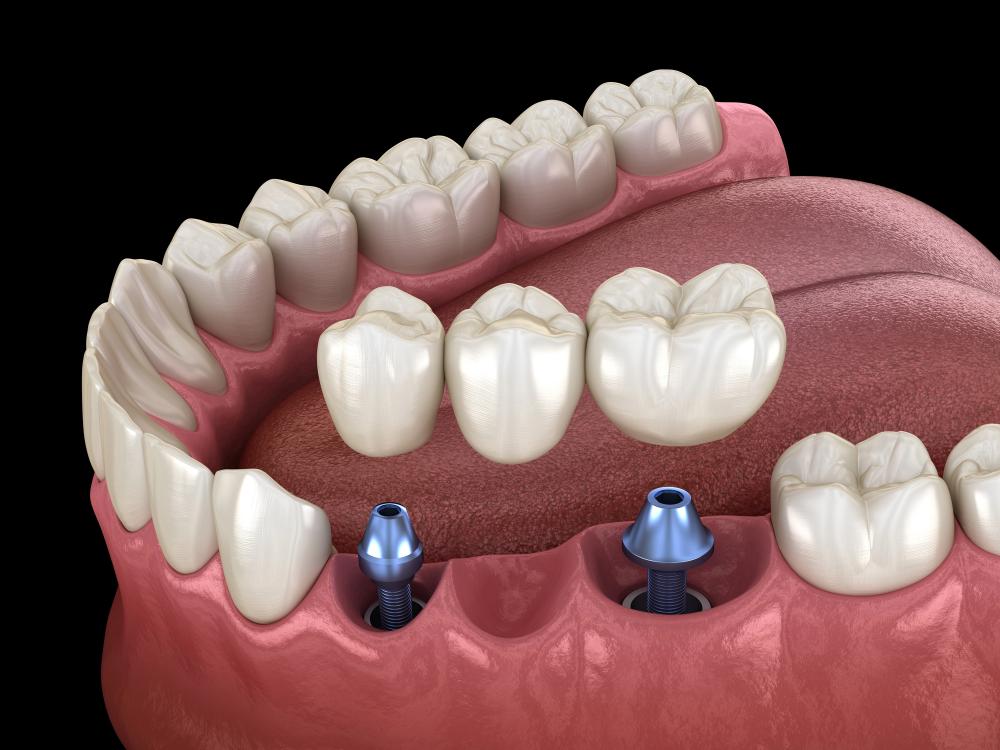 types of dental bridges