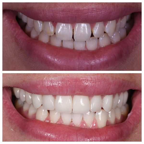 Smile Gallery Before and After