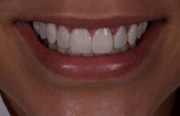 Smiling Teeth