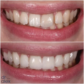 Here’s a closer look at the transformation we shared in the recent Dental Science. What started with 6 veneers addressing gaps, dark tooth and flared front teeth turned into 10 #porcelainveneers. We had a little break in between. Check out the D.S. if you’re interested in the whole process.

#dentalscience #cosmeticdentistry #nyccosmeticdentist #smilecorrection