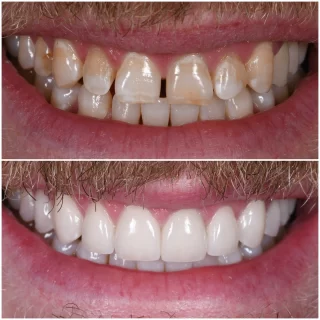This is not a straight forward #porcelainveneers case.  Must prioritizing a healthy oral cavity followed by pretty teeth.  2 year after completion of his work everything is stable and he frequents the office for routine care. 

#CosmeticDentistNYC  #HealthySmileFirst  #PorcelainVeneers  #SmileTransformation 
#NYCDentist  #OralHealthMatters #HealthyTeeth 
#DentalCareNYC #VeneersJourney #TwoYearsLater 
#SmileMakeover #PatientCareFirst #DentalWellness 
#NYCBeauty #ComprehensiveDentistry #CosmeticDentistry  #VeneerSuccess #DentalExcellence #RoutineCare #StableSmile