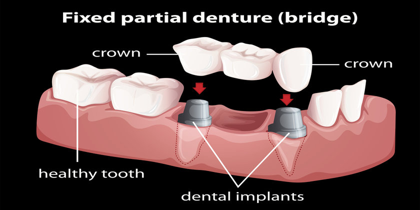 dental bridges or dental implants