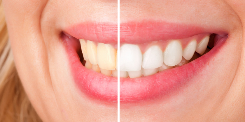 teeth whitening experience