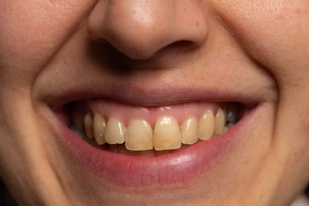 10 Things That May Cause Tooth Discoloration