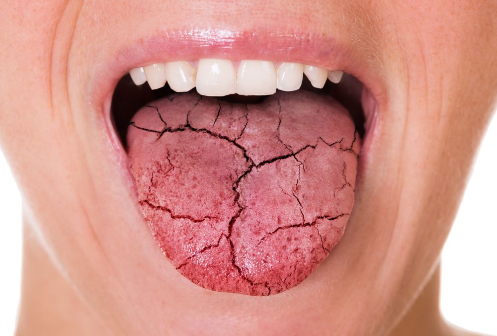 15 Simple Dry Mouth Remedies To Try