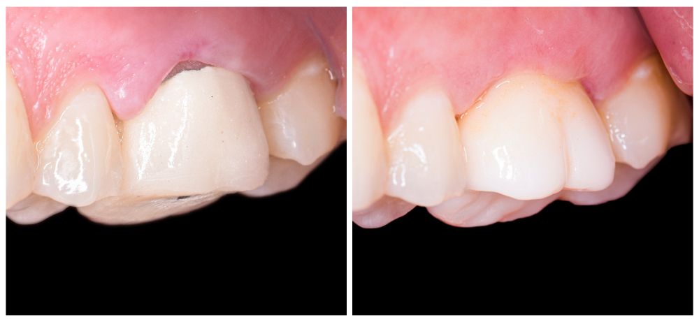 3 Consequences That Happen If You Don’t Replace Your Veneers