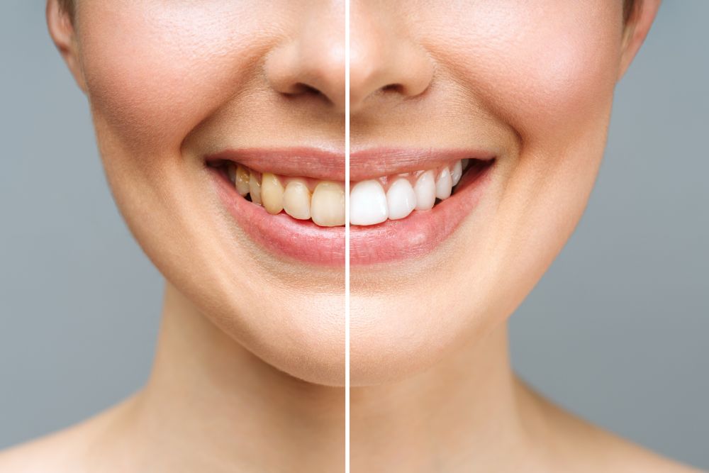 7 Signs You Should Go with Teeth Whitening Service