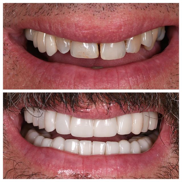 Smile Gallery Before and After