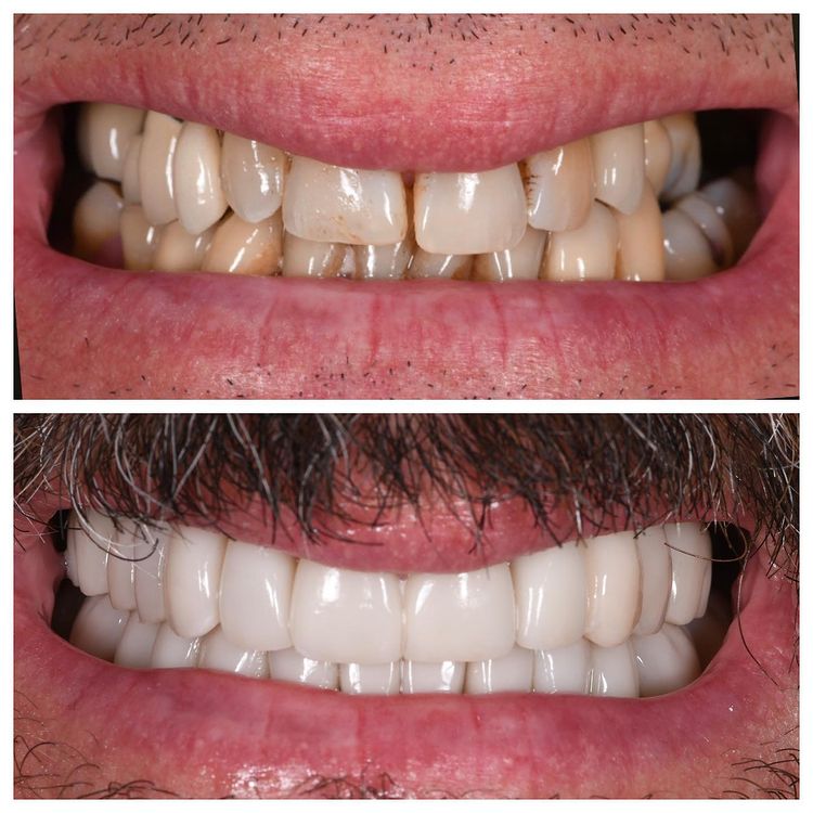 Smile Gallery Before and After